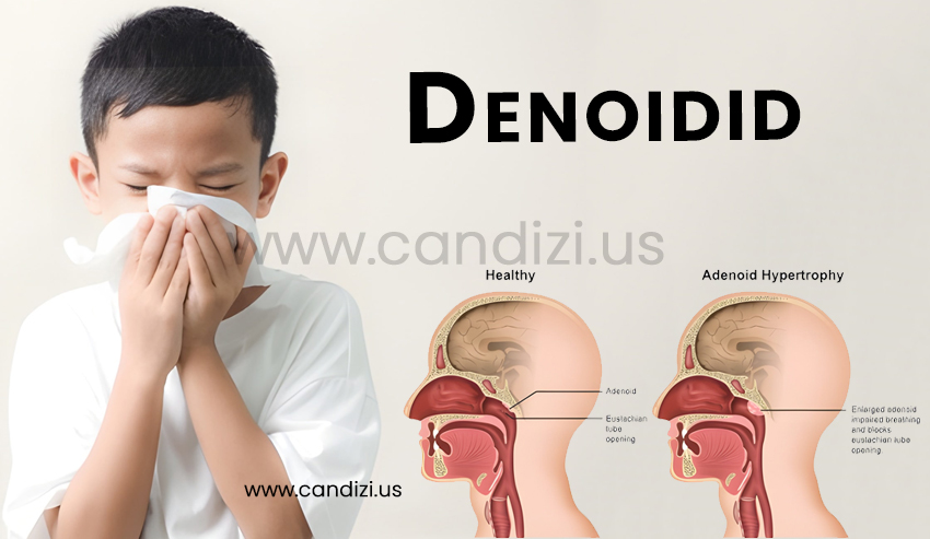 Denoidid: Causes, Symptoms, Treatment & Recovery Guide
